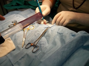 Using the laser to remove the ovary and uterus. 